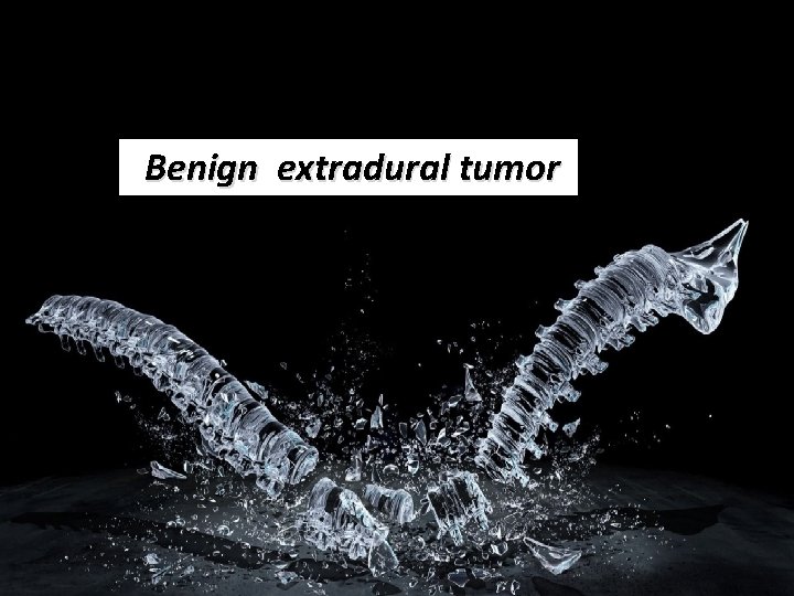 Benign extradural tumor 