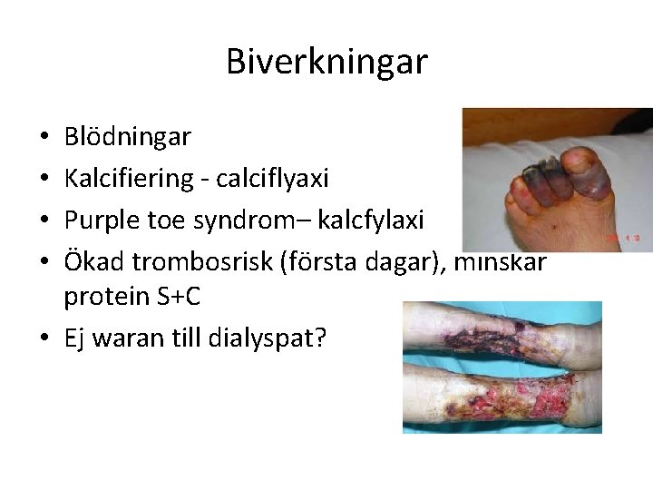 Biverkningar Blödningar Kalcifiering - calciflyaxi Purple toe syndrom– kalcfylaxi Ökad trombosrisk (första dagar), minskar