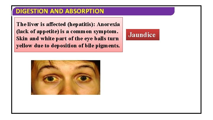 DIGESTION AND ABSORPTION The liver is affected (hepatitis): Anorexia (lack of appetite) is a