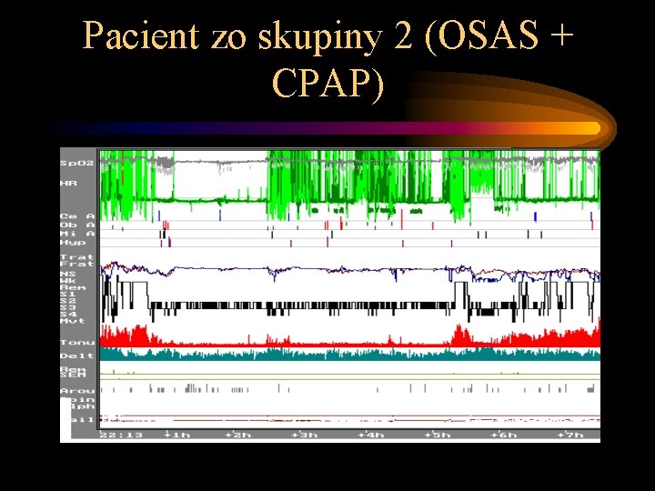 Pacient zo skupiny 2 (OSAS + CPAP) 