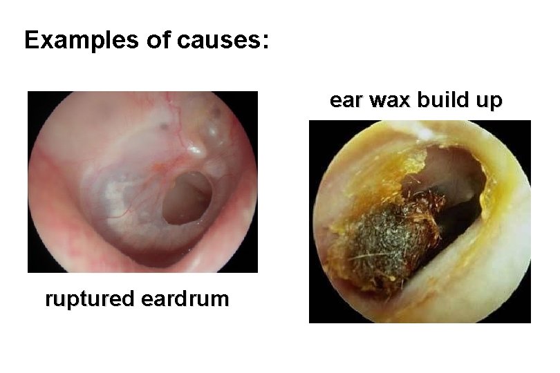 Examples of causes: ear wax build up ruptured eardrum 