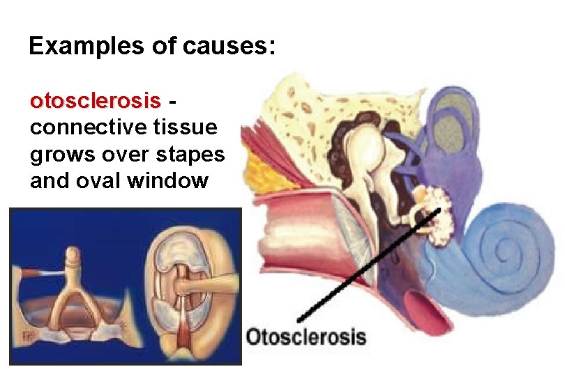 Examples of causes: otosclerosis connective tissue grows over stapes and oval window 