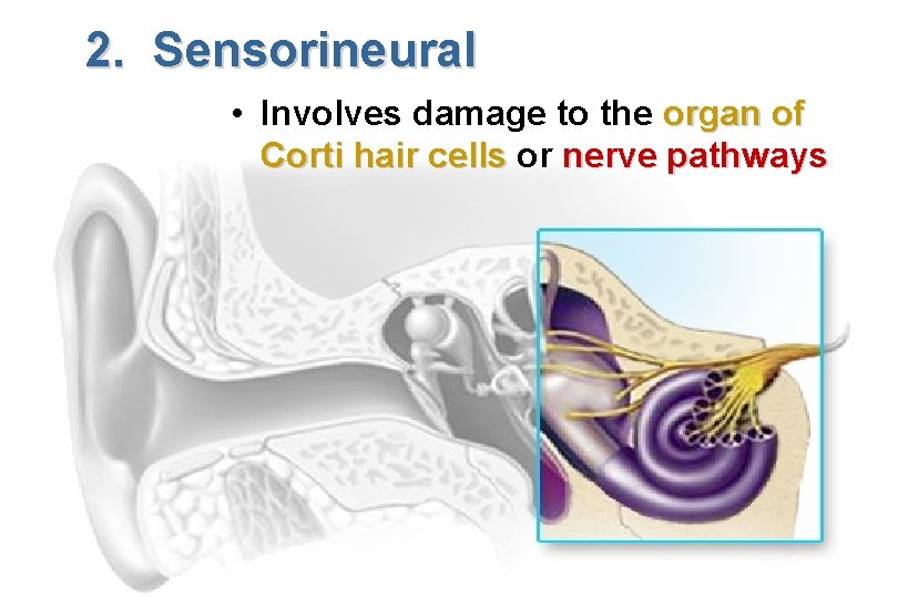 2. Sensorineural • Involves damage to the organ of Corti hair cells or nerve