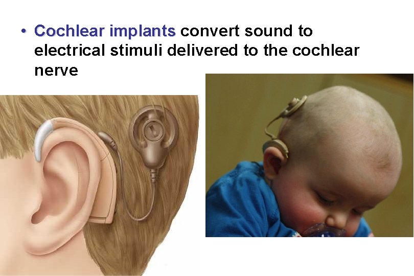  • Cochlear implants convert sound to electrical stimuli delivered to the cochlear nerve