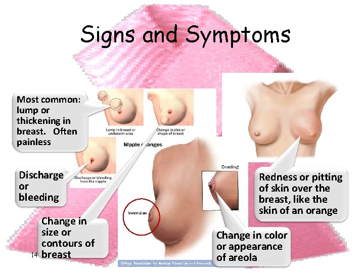 Signs and Symptoms Most common: lump or thickening in breast. Often painless Discharge or