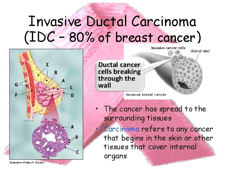 Invasive Ductal Carcinoma (IDC – 80% of breast cancer) Ductal cancer cells breaking through