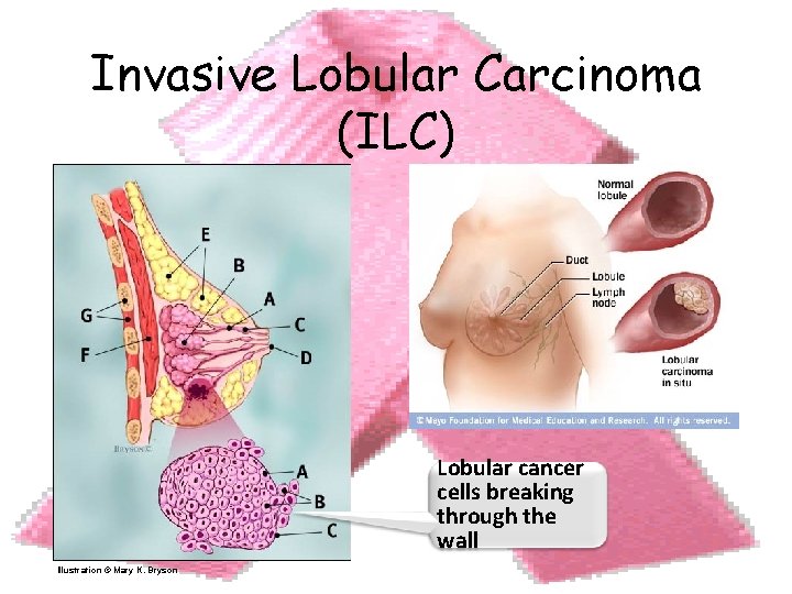 Invasive Lobular Carcinoma (ILC) 18 Illustration © Mary K. Bryson Lobular cancer cells breaking