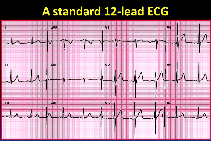 A standard 12 -lead ECG 