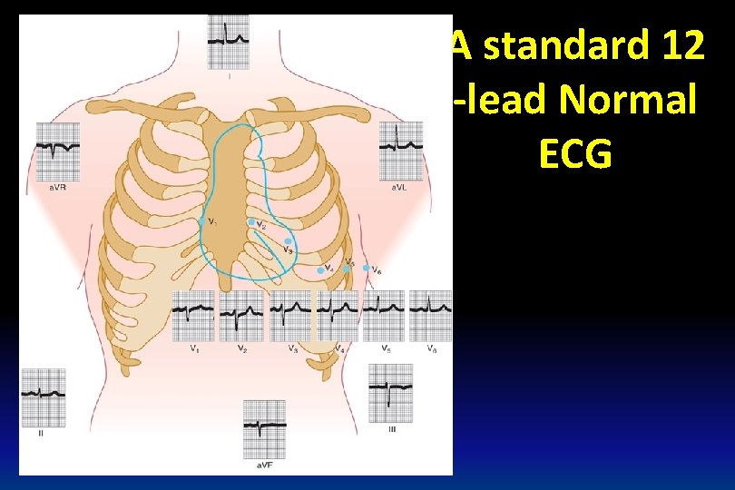 A standard 12 -lead Normal ECG 