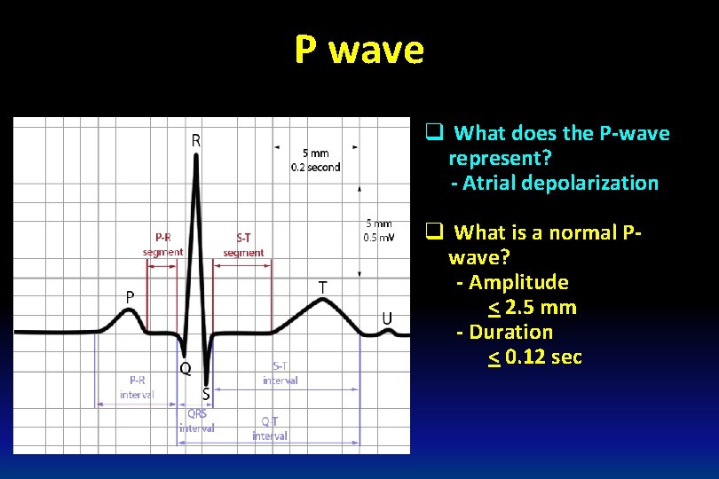 P wave q What does the P-wave represent? - Atrial depolarization q What is