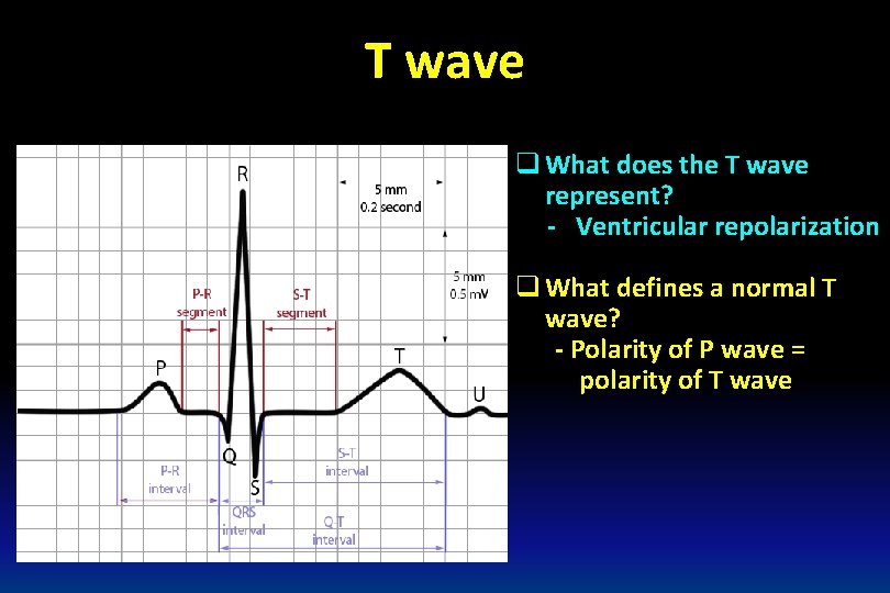 T wave q What does the T wave represent? - Ventricular repolarization q What