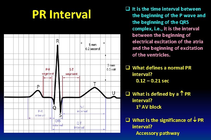 PR Interval q It is the time interval between the beginning of the P