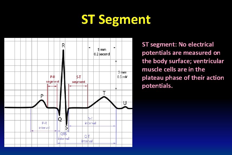 ST Segment ST segment: No electrical potentials are measured on the body surface; ventricular