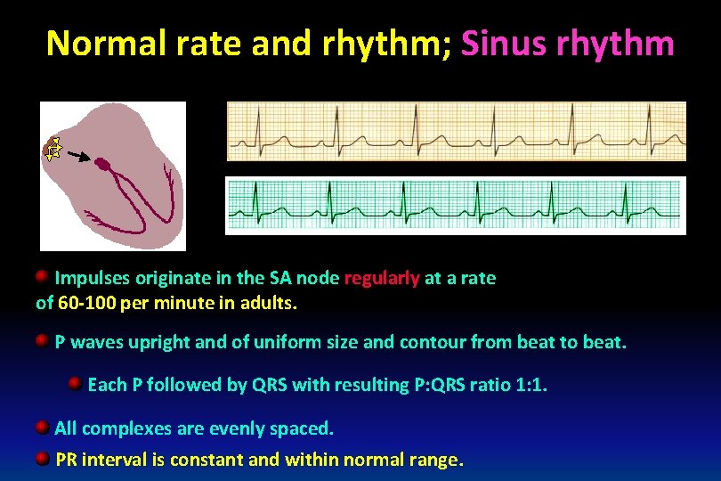 Normal rate and rhythm; Sinus rhythm Impulses originate in the SA node regularly at