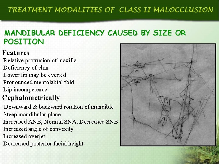 MANDIBULAR DEFICIENCY CAUSED BY SIZE OR POSITION Features Relative protrusion of maxilla Deficiency of