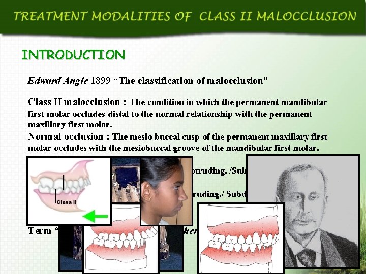INTRODUCTION Edward Angle 1899 “The classification of malocclusion” Class II malocclusion : The condition