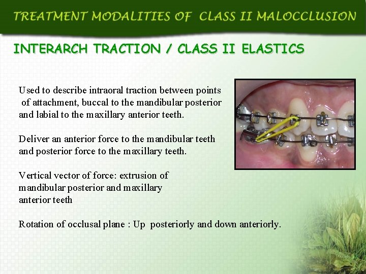 INTERARCH TRACTION / CLASS II ELASTICS Used to describe intraoral traction between points of