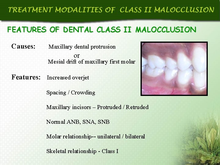 FEATURES OF DENTAL CLASS II MALOCCLUSION Causes: Maxillary dental protrusion or Mesial drift of