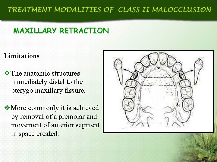 MAXILLARY RETRACTION Limitations v. The anatomic structures immediately distal to the pterygo maxillary fissure.