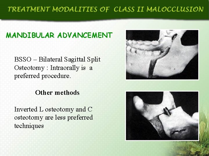 MANDIBULAR ADVANCEMENT BSSO – Bilateral Sagittal Split Osteotomy : Intraorally is a preferred procedure.