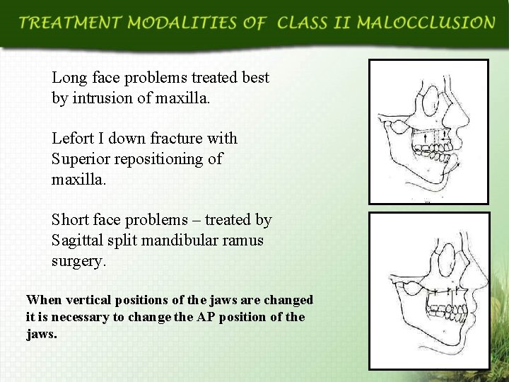 Long face problems treated best by intrusion of maxilla. Lefort I down fracture with