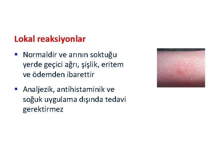 Lokal reaksiyonlar § Normaldir ve arının soktuğu yerde geçici ağrı, şişlik, eritem ve ödemden