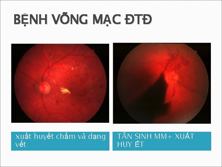 BỆNH VÕNG MẠC ĐTĐ xuất huyết chấm và dạng vết T N SINH MM+