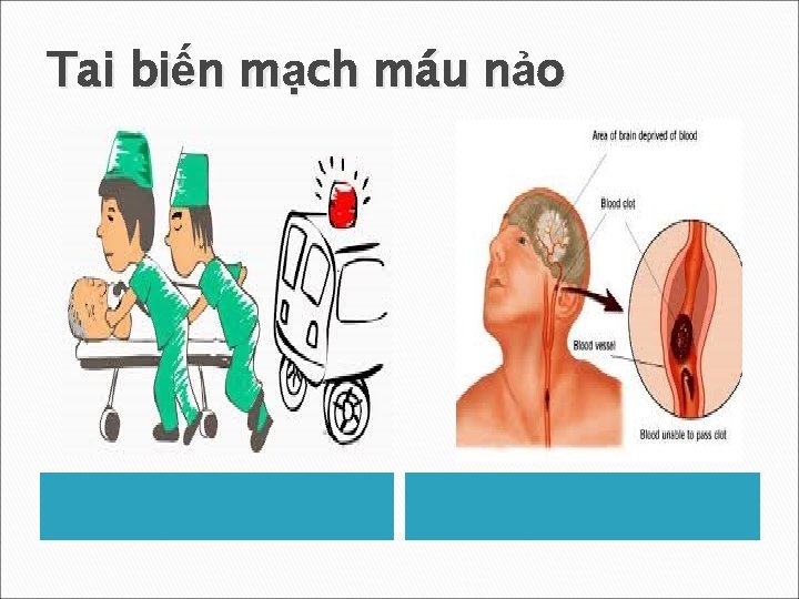 Tai biến mạch máu nảo 