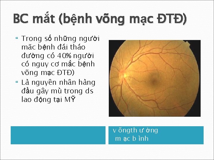 BC mắt (bệnh võng mạc ĐTĐ) Trong số những người măc bệnh đái tháo
