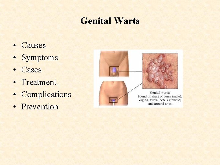 Genital Warts • • • Causes Symptoms Cases Treatment Complications Prevention 