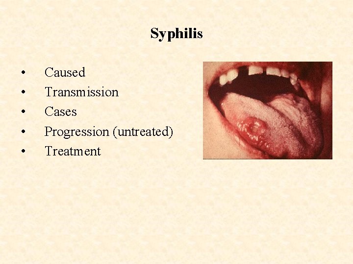 Syphilis • • • Caused Transmission Cases Progression (untreated) Treatment 