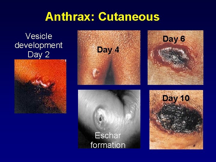 Anthrax: Cutaneous Vesicle development Day 2 Day 6 Day 4 Day 10 Eschar formation