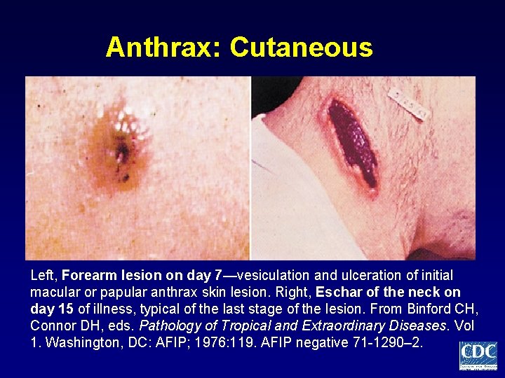 Anthrax: Cutaneous Left, Forearm lesion on day 7—vesiculation and ulceration of initial macular or