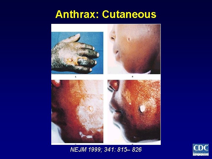Anthrax: Cutaneous NEJM 1999; 341: 815– 826 
