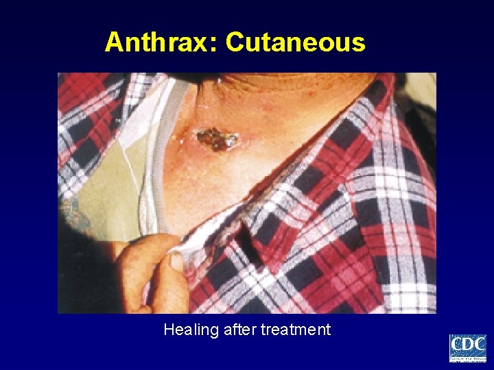 Anthrax: Cutaneous Healing after treatment 