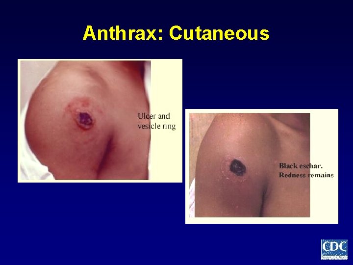 Anthrax: Cutaneous 