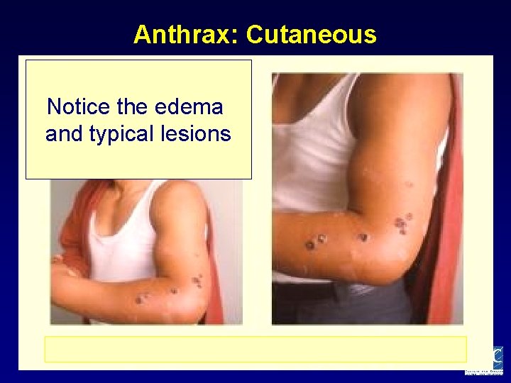 Anthrax: Cutaneous Notice the edema and typical lesions 
