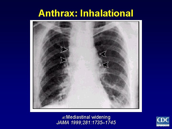 Anthrax: Inhalational Mediastinal widening JAMA 1999; 281: 1735– 1745 