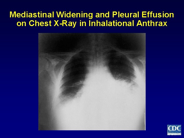 Mediastinal Widening and Pleural Effusion on Chest X-Ray in Inhalational Anthrax 