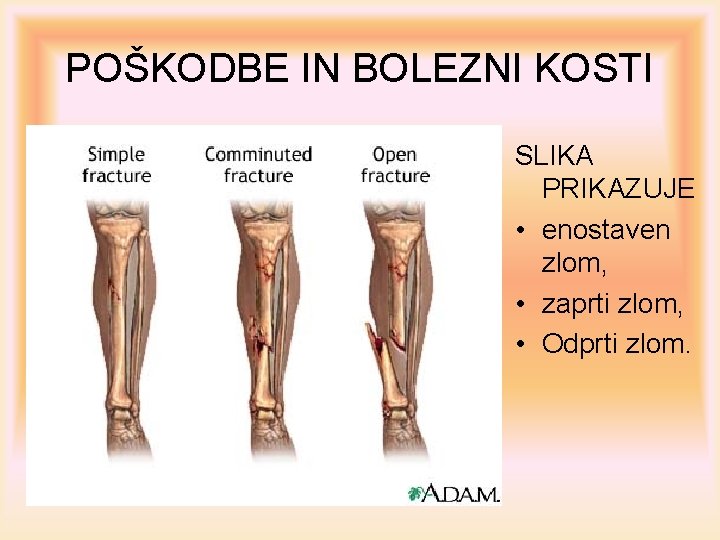 POŠKODBE IN BOLEZNI KOSTI SLIKA PRIKAZUJE • enostaven zlom, • zaprti zlom, • Odprti