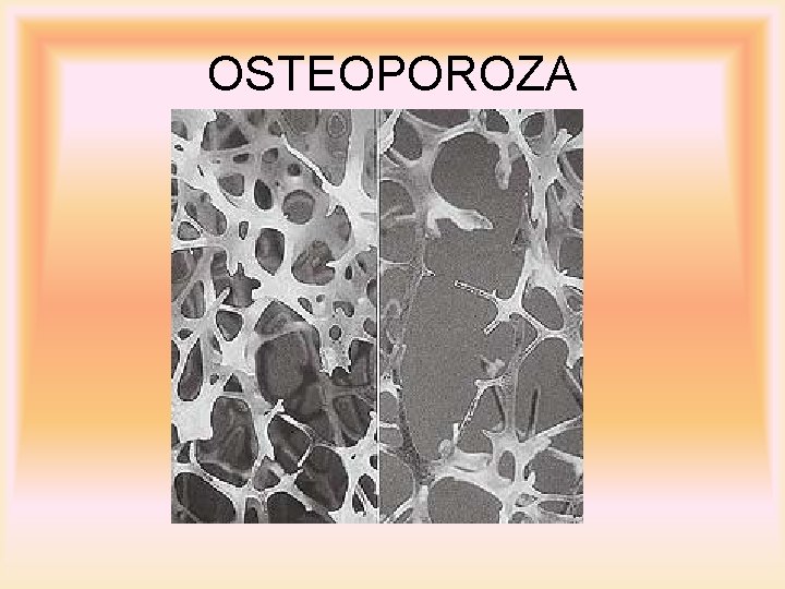 OSTEOPOROZA 