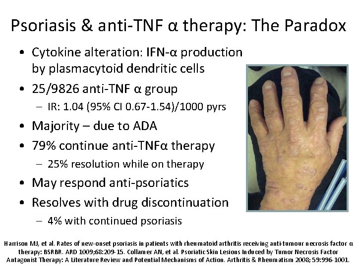 Psoriasis & anti-TNF α therapy: The Paradox • Cytokine alteration: IFN-α production by plasmacytoid