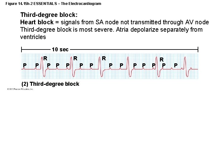 Figure 14. 15 h-2 ESSENTIALS – The Electrocardiogram Third-degree block: Heart block = signals