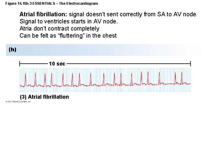 Figure 14. 15 h-3 ESSENTIALS – The Electrocardiogram Atrial fibrillation: signal doesn’t sent correctly