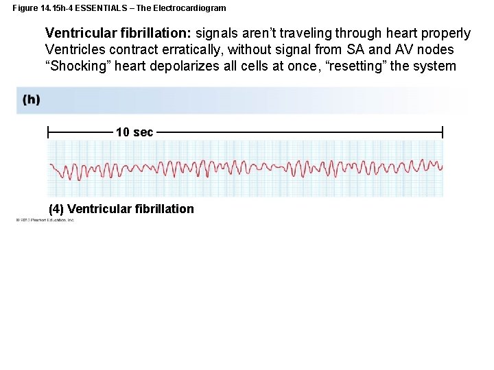 Figure 14. 15 h-4 ESSENTIALS – The Electrocardiogram Ventricular fibrillation: signals aren’t traveling through