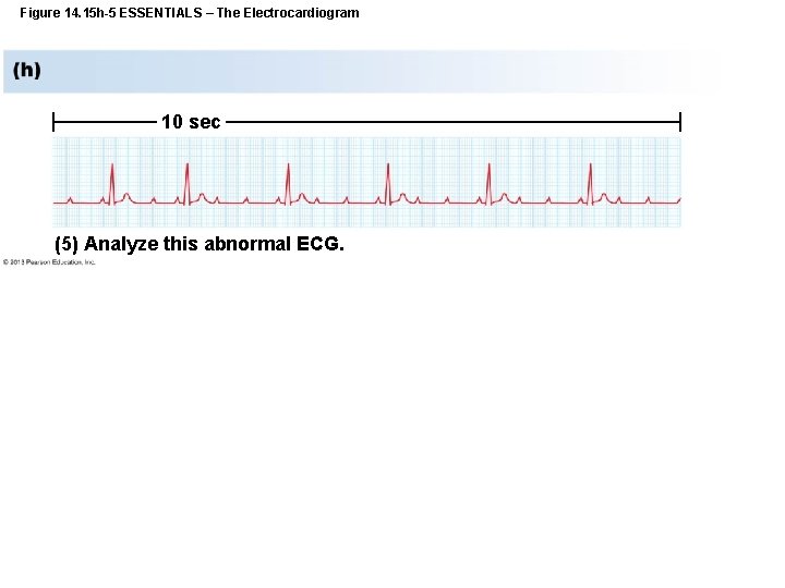 Figure 14. 15 h-5 ESSENTIALS – The Electrocardiogram 10 sec (5) Analyze this abnormal