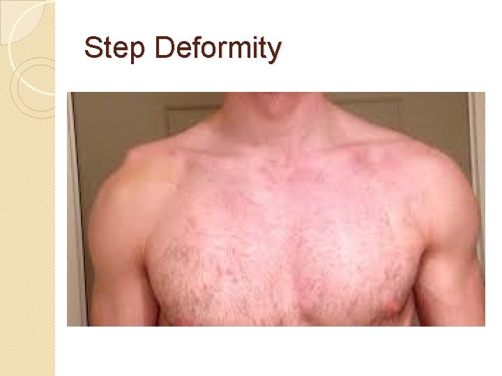 Step Deformity 