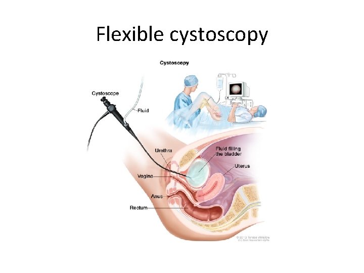 Flexible cystoscopy 