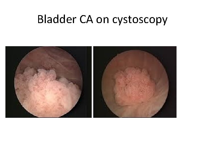 Bladder CA on cystoscopy 