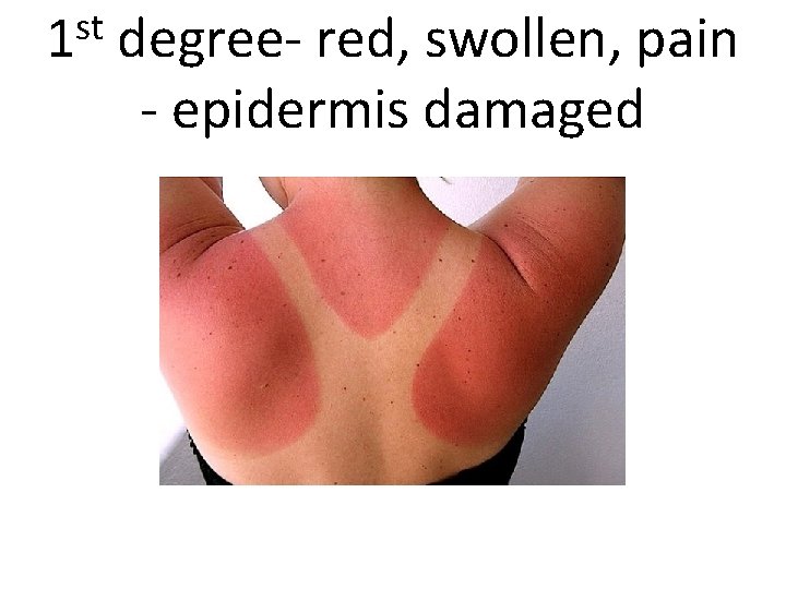 st 1 degree- red, swollen, pain - epidermis damaged 